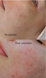 ošetrenie pleti